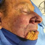 Nose reconstruction from skin cancer removal with Melolabial flap - Man - Case 16508 - Intraoperative - Oblique view