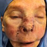 Nose reconstruction from skin cancer removal with Burow's Triangle Displacement flap - Woman - Case 16515 - Intraoperative - Frontal view