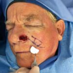 Nose reconstruction from skin cancer removal with Melolabial flap - Man - Case 16520 - Intraoperative - Oblique view
