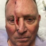 Nose reconstruction from skin cancer removal with Melolabial flap - Man - Case 16523 - Intraoperative - Frontal view