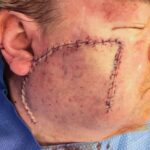 Cheek wound reconstruction from skin cancer removal with Cervicofacial flap - Man - Case 111214 - Intraoperative - Lateral view