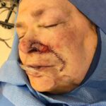 Nasal reconstruction from skin cancer removal with Melolabial flap - Woman - Case 16527 - Intraoperative - Oblique view