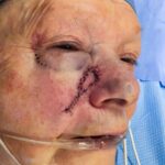 Cheek wound reconstruction from skin cancer removal with V-Y advancement flap - Woman - Case 111216 - Intraoperative - Oblique view