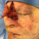 Cheek wound reconstruction from skin cancer removal with Dorsal Sliding advancement flap - Woman - Case 111217 - Intraoperative - Oblique view