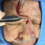 Forehead reconstruction from skin cancer removal with Burow's Triangle Displacement flap - Woman - Case 15406 - Intraoperative - Frontal view