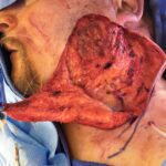 Cheek wound reconstruction from skin cancer removal with large Cervicofacial flap - Man - Case 11122 - Intraoperative - Profile view
