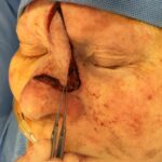 Cheek wound reconstruction from skin cancer removal with Dorsal Sliding advancement flap - Woman - Case 111217 - Intraoperative - Oblique view