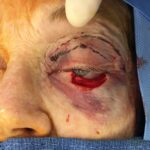 Left lower eyelid reconstruction from skin cancer with Hughes tarsoconjunctival flap & skin graft - Woman - Case 15405 - Intraoperative - Frontal view