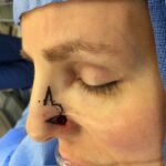 Nose reconstruction from skin cancer removal with Bilobed Rotational flap - Woman - Case 16510 - Intraoperative - Oblique view