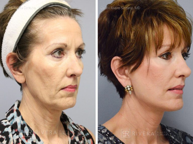 Short scar facelift (mini facelift), fat transfer (grafting) to the face, & TCA peel - Woman - Case 11101 - Before and after - Oblique view