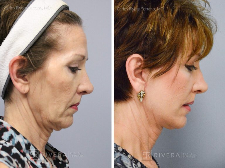 Short scar facelift (mini facelift), fat transfer (grafting) to the face, & TCA peel - Woman - Case 11101 - Before and after - Profile view