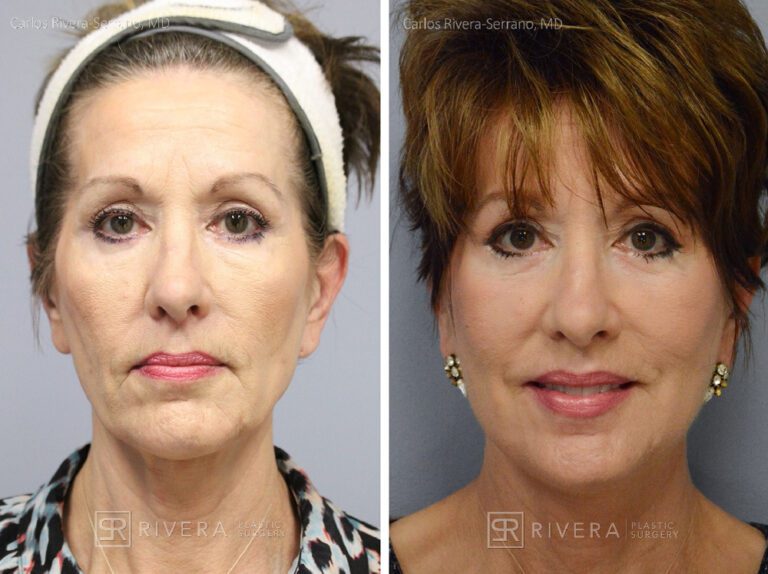 Short scar facelift (mini facelift), fat transfer (grafting) to the face, & TCA peel - Woman - Case 11101 - Before and after o procedure - " " view