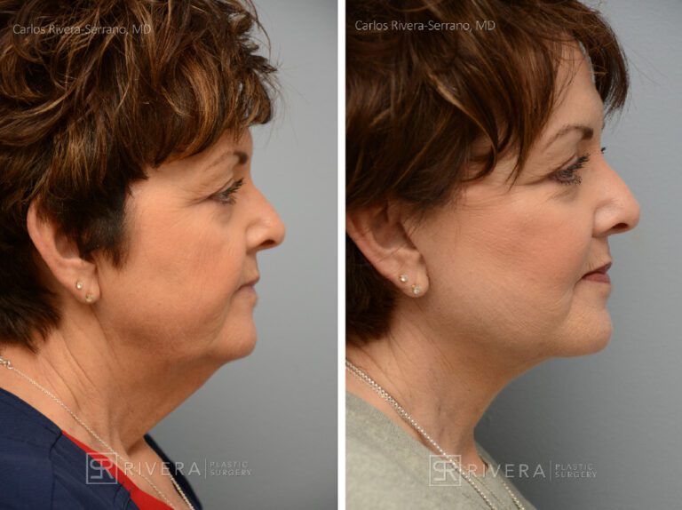 Facelift - Woman - Case 11110 - Before and after - Profile view