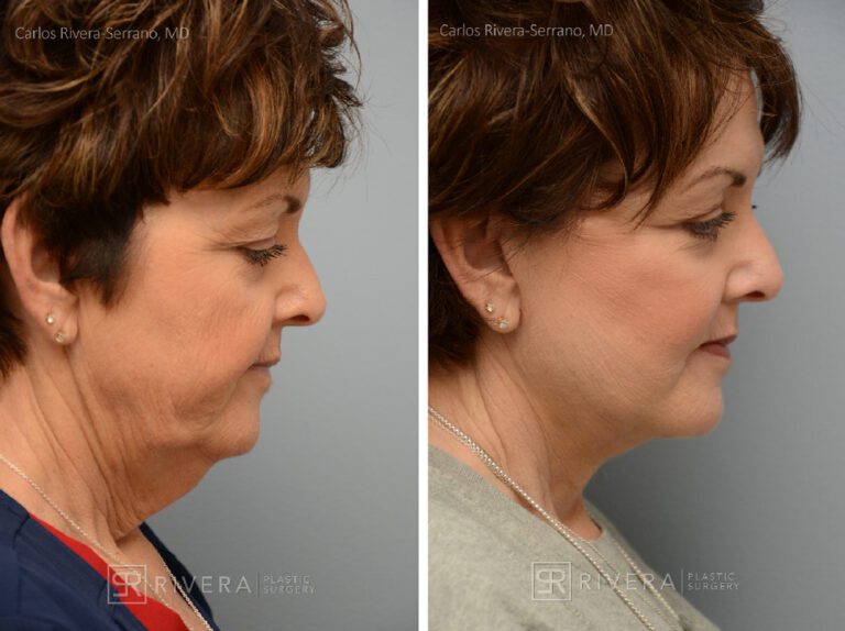 Facelift - Woman - Case 11110 - Before and after - Profile view