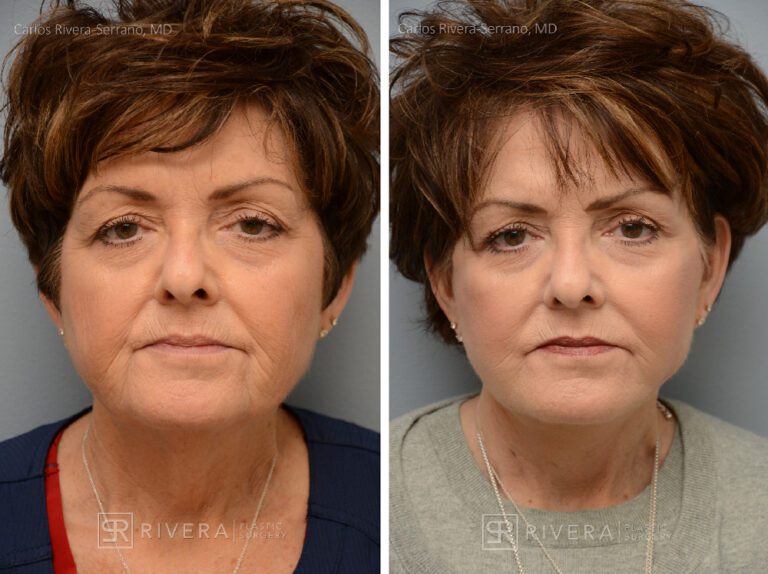 Facelift - Woman - Case 11110 - Before and after - Frontal view