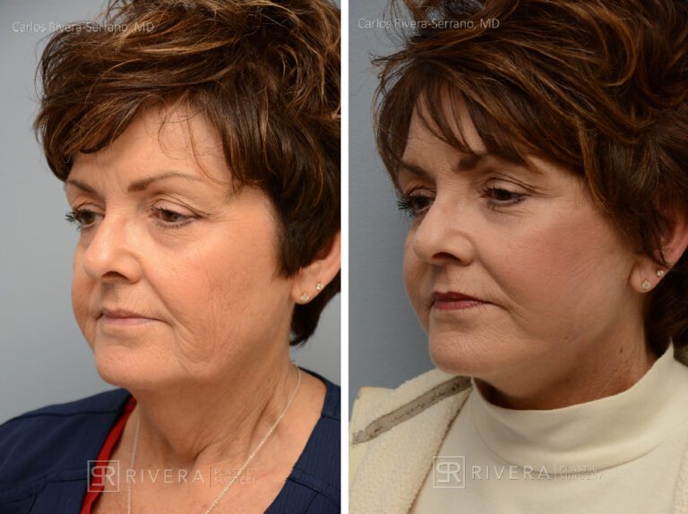 Facelift - Woman - Case 11110 - Before and after - Oblique view