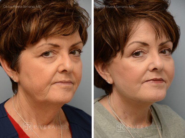 Facelift - Woman - Case 11110 - Before and after - Oblique view