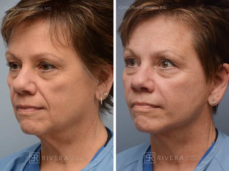 Facelift - Woman - Case 11111 - Before and after - Oblique view