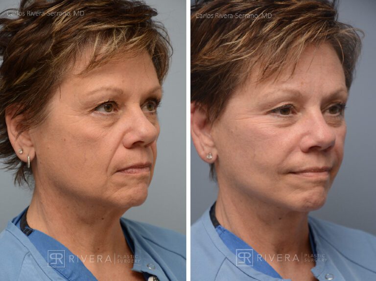 Facelift - Woman - Case 11111 - Before and after - Oblique view