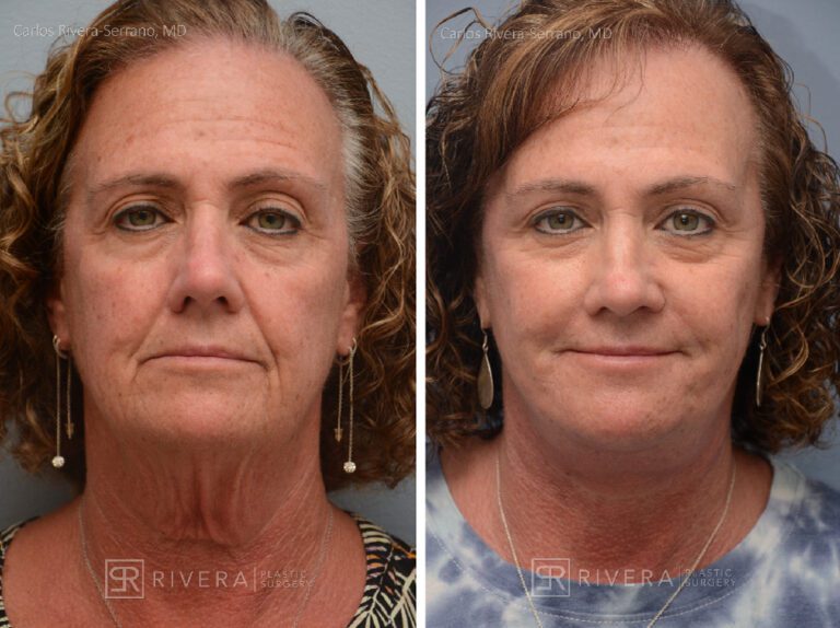 Facelift - Woman - Case 11112 - Before and after - Frontal view