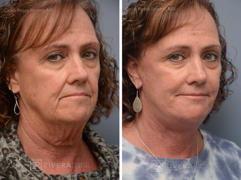 Facelift - Woman - Case 11112 - Before and after - Oblique view