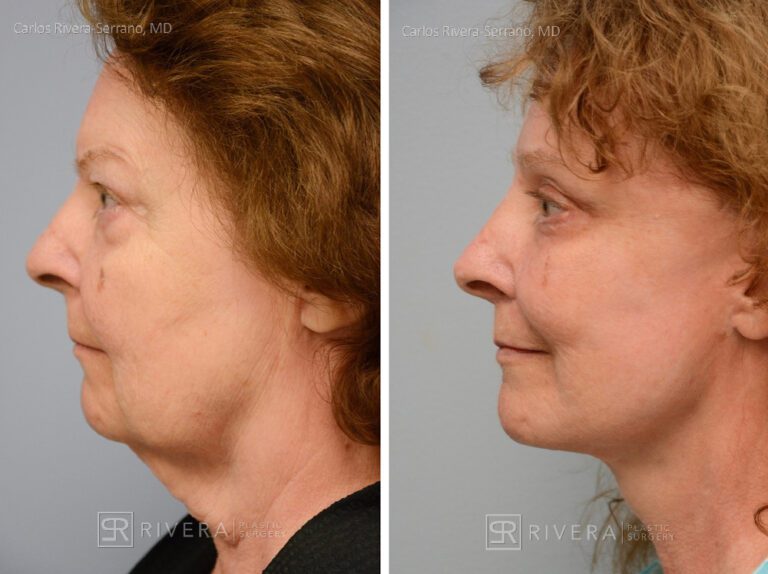 Facelift, brow lift, upper and lower eyelid surgery, lip lift, fat transfer (grafting) to the face, TCA peel, hyaluronic acid fillers around mouth -Woman - Case 13101 - Before and after - Lateral View