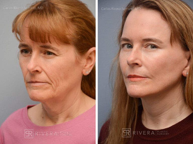 Facelift, lateral brow lift, upper and lower eyelid surgery, fat transfer (grafting) to the face (2 sessions), TCA peel, hyaluronic acid fillers around mouth - Woman - Case 13102 - Before and after - Oblique view