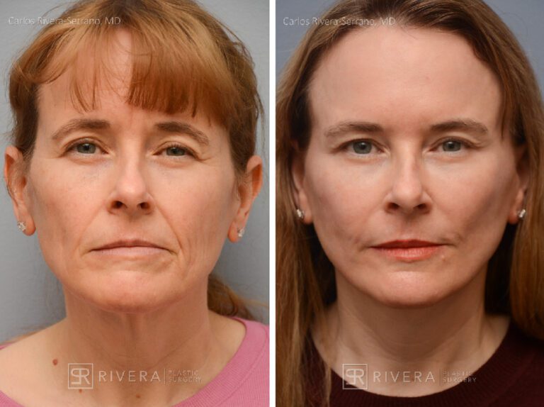 Facelift, lateral brow lift, upper and lower eyelid surgery, fat transfer (grafting) to the face (2 sessions), TCA peel, hyaluronic acid fillers around mouth - Woman - Case 13102 - Before and after - Frontal view