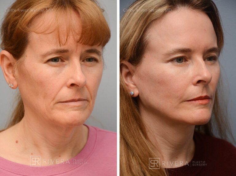 Facelift, lateral brow lift, upper and lower eyelid surgery, fat transfer (grafting) to the face (2 sessions), TCA peel, hyaluronic acid fillers around mouth - Woman - Case 11103 - Before and after - Oblique view