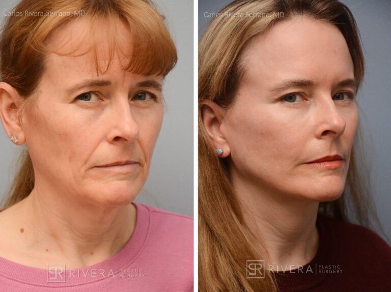 Facelift, lateral brow lift, upper and lower eyelid surgery, fat transfer (grafting) to the face (2 sessions), TCA peel, hyaluronic acid fillers around mouth - Woman - Case 11103 - Before and after - Oblique view