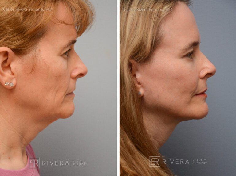 Facelift, lateral brow lift, upper and lower eyelid surgery, fat transfer (grafting) to the face (2 sessions), TCA peel, hyaluronic acid fillers around mouth - Woman - Case 13102 - Before and after - Lateral view