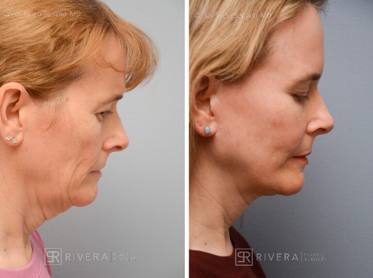 Facelift, lateral brow lift, upper and lower eyelid surgery, fat transfer (grafting) to the face (2 sessions), TCA peel, hyaluronic acid fillers around mouth - Woman - Case 13102 - Before and after - Lateral view