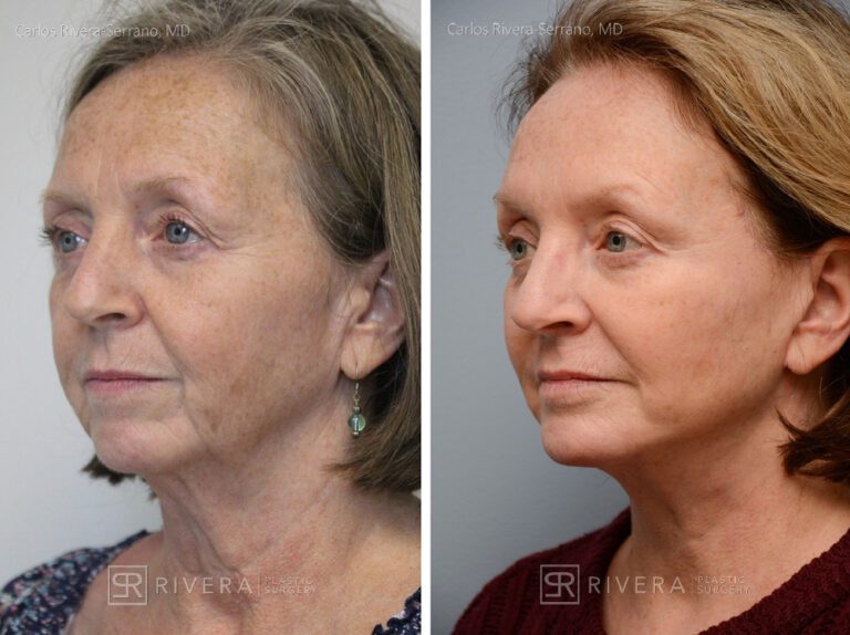 Facelift, chin augmentation with implant - Woman - Case 11104 - Before and after - Oblique view