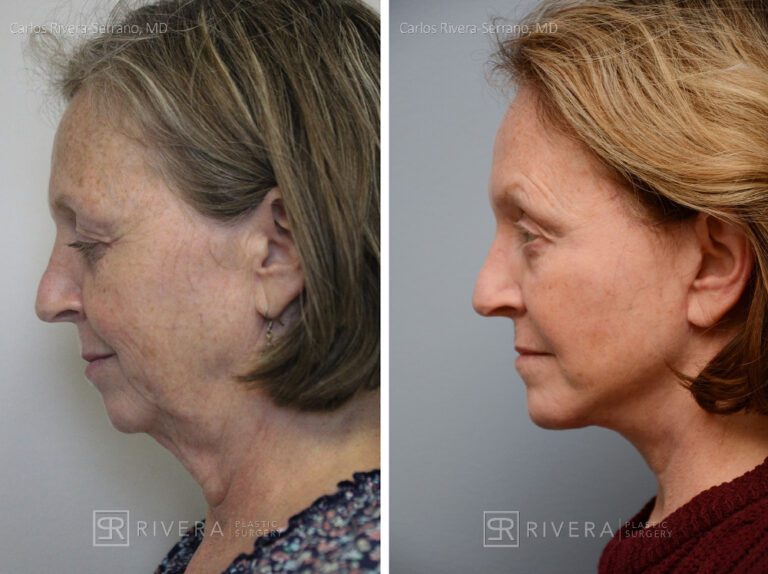 Facelift, chin augmentation with implant - Woman - Case 11104 - Before and after - Profile View