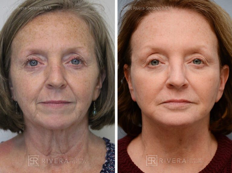 Facelift, chin augmentation with implant - Woman - Case 11104 - Before and after - Frontal view