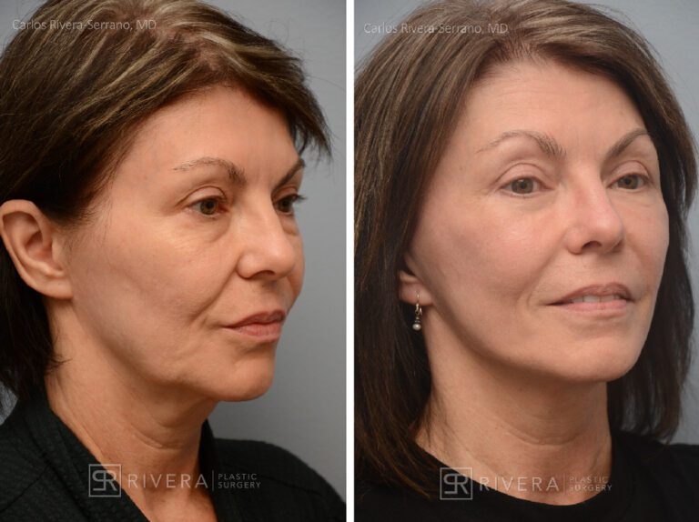 Short scar facelift & fat transfer (grafting) to the face, upper and lower eyelid surgery, & TCA peel - Woman - Case 13103 - Before and after - Oblique view