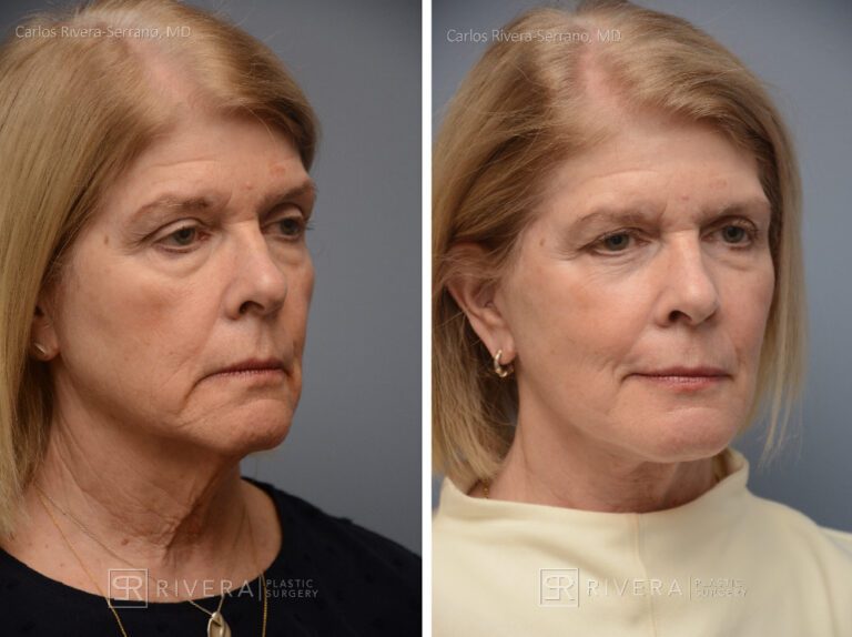 Facelift - Woman - Case 11106 - Before and after - Oblique view