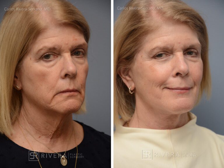Facelift - Woman - Case 11106 - Before and after - Oblique view