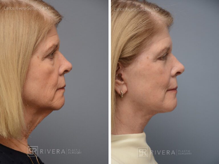 Facelift - Woman - Case 11106 - Before and after - Profile view