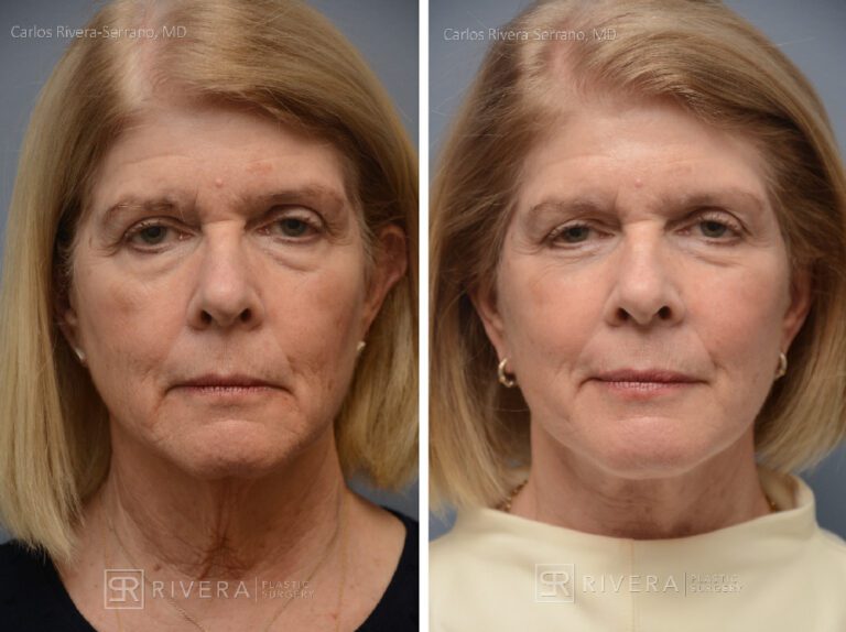 Facelift - Woman - Case 11106 - Before and after - Frontal View