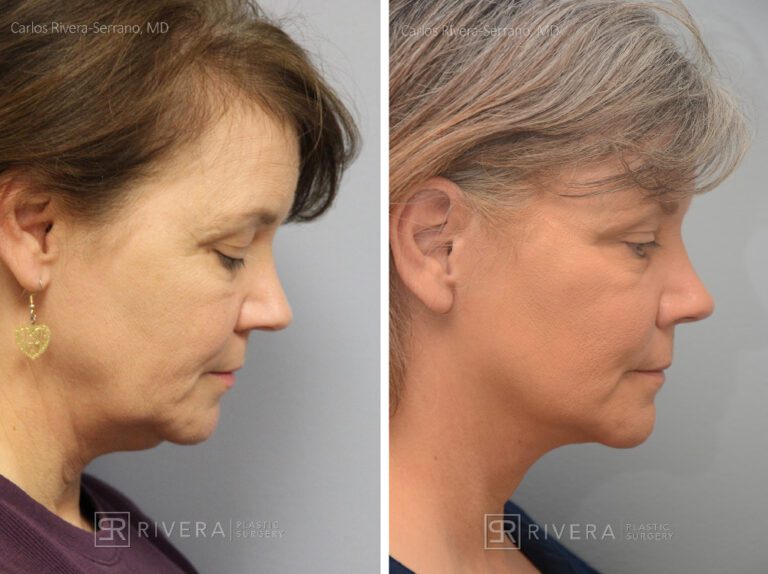 Facelift - Woman - Case 11107 - Before and after - Profile view