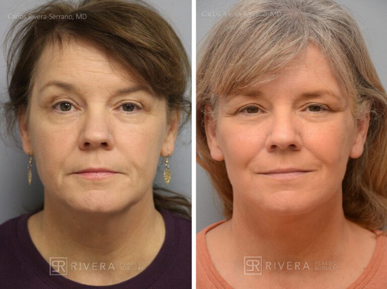Facelift - Woman - Case 11107 - Before and after - Frontal view