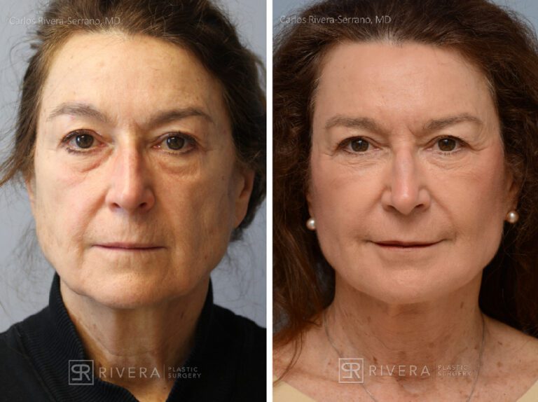 Short scar facelift, fat transfer to the face, TCA peel - Woman - Case 11108 - Before and after - Frontal view