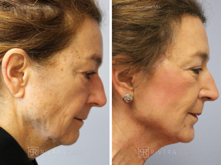 Short scar facelift, fat transfer to the face, TCA peel - Woman - Case 11108 - Before and after - Profile view