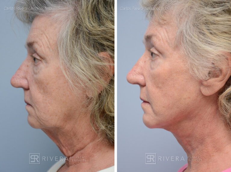 Facelift - Woman - Case 11109 - Before and after - Profile view