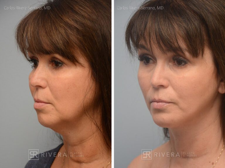 Neck lift, chin augmentation with implant - Woman - Case 12101 - Before and after - Oblique view