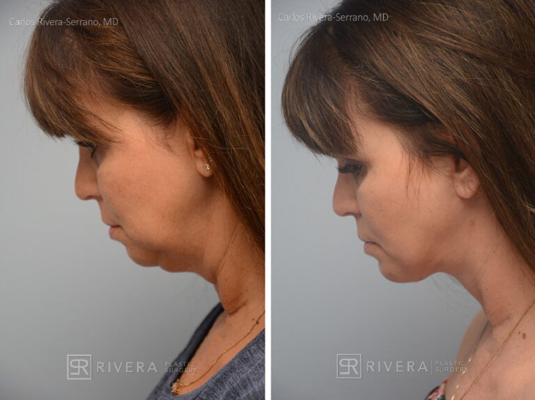 Neck lift, chin augmentation with implant - Woman - Case 12101 - Before and after - Lateral view