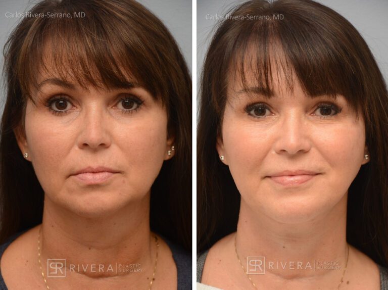 Neck lift, chin augmentation with implant - Woman - Case 12101 - Before and after - Frontal view