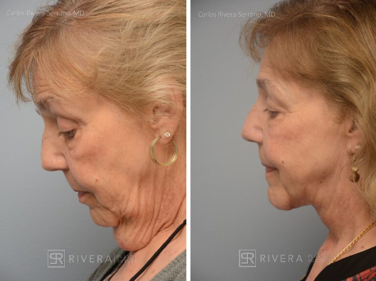 Direct Necklift (vertical scar placed in the front of the neck) - Woman - Case 12103 - Before and after - Lateral view