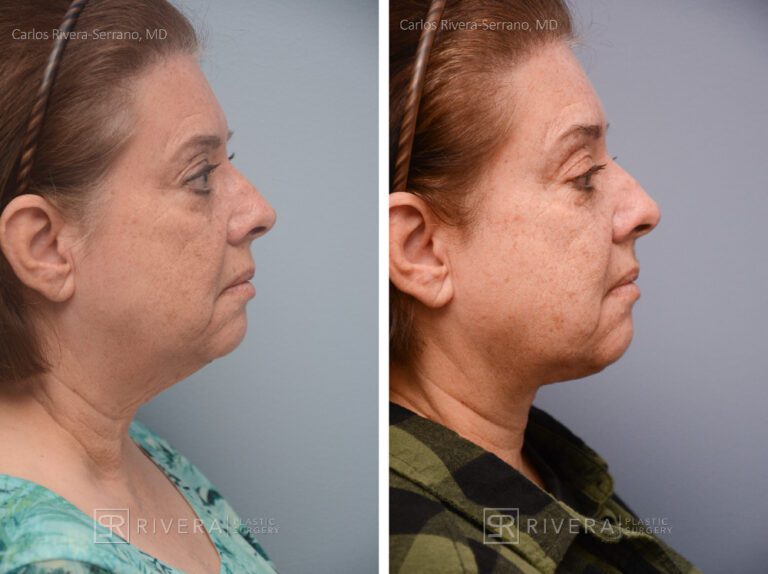 Direct Neck lift (vertical scar placed in the front of the neck) - Woman - Case 12107 - Before and after - Lateral view